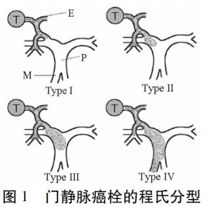 肝细胞癌合并门静脉癌栓的治疗